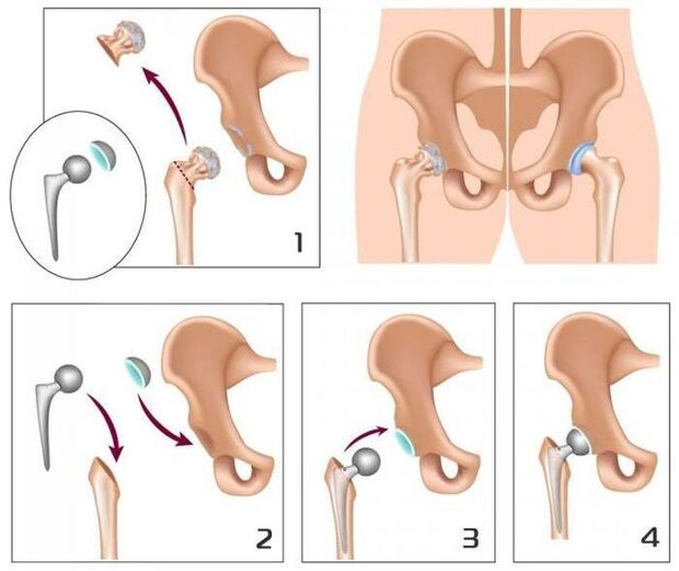 Replace a painful joint with a prosthesis