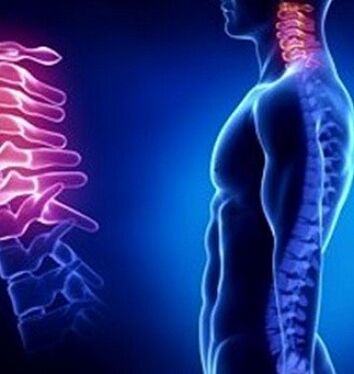 Cervical osteochondrosis can be caused by injuries to the neck.