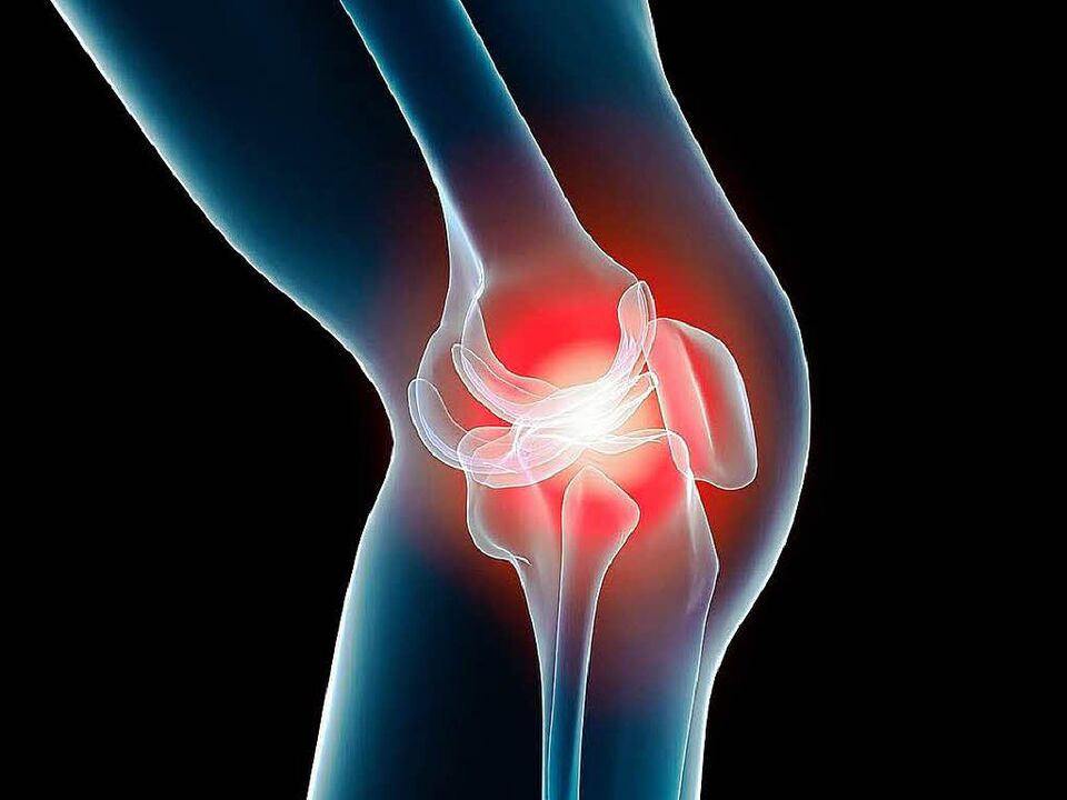 knee osteoarthritis