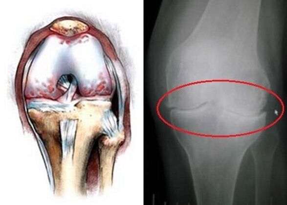 osteoarthritis of the knee joint