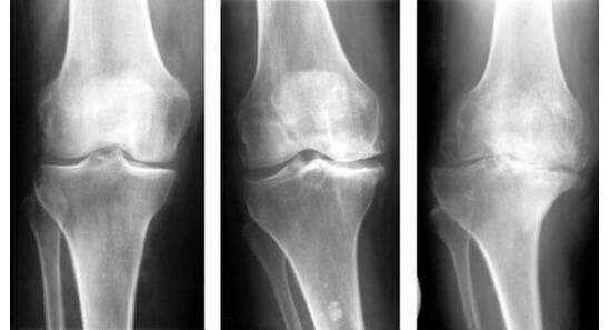 A mandatory diagnostic measure when identifying osteoarthritis of the knee is an x-ray.