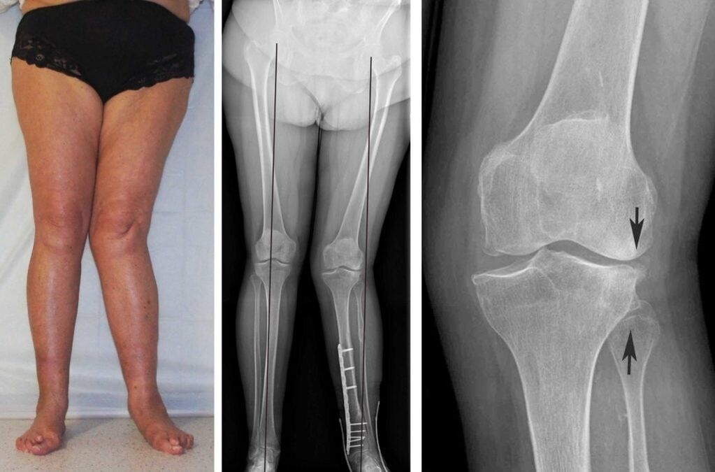 Advanced osteoarthritis of the knee joints is clearly visible even without x-rays.
