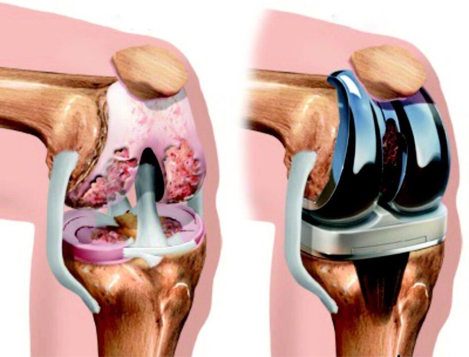 In case of complete damage to the knee joint due to osteoarthritis, it can be restored using endoprostheses.